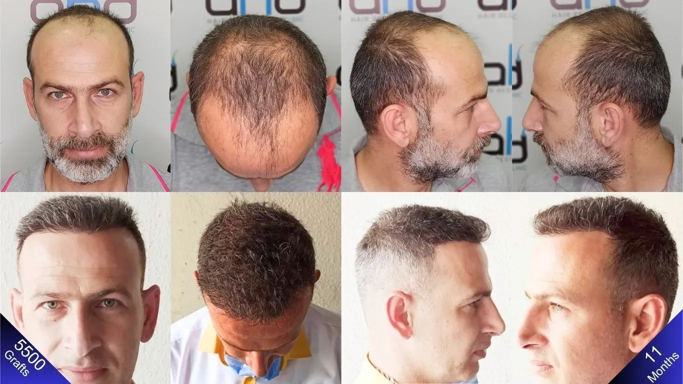 Hoe ziet een 5500-greffe haartransplantatie eruit in Turkije? Hier is het antwoord waar je naar op zoek bent.