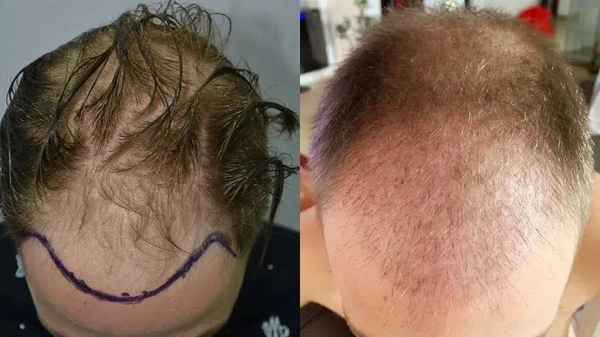 iki aylık şok dökülme dönemi