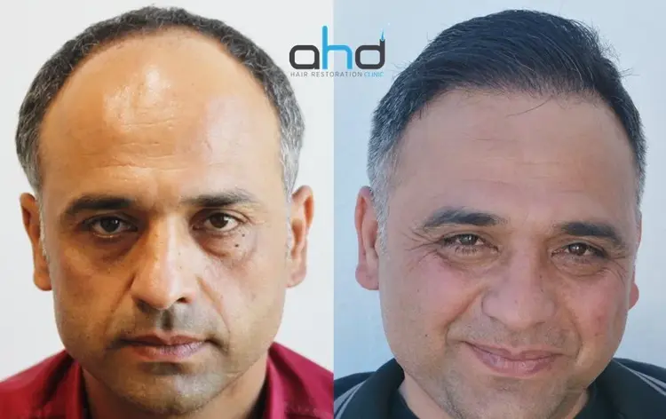 saç ekimi öncesi ve sonrasını gösteren mükemmel bir görsel