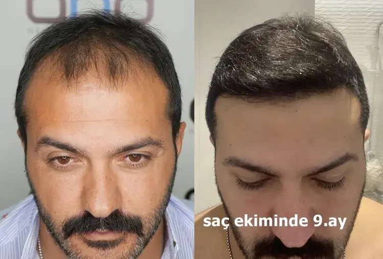 saç ekimi yapılan erkekte 9 ay sonrasında muhteşem değişim