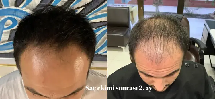 saç ekiminde 2 aylık görünüm