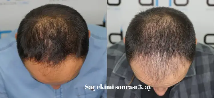 saç ekimi 3 ay sonrası