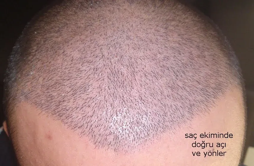 saç ekiminde doğru açı doğallık için çok önemlidir