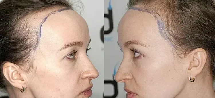 transplante capilar feminino