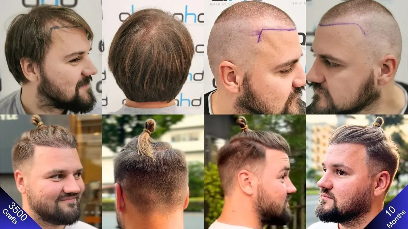 10 meses após o transplante de 3500 enxertos de cabelo