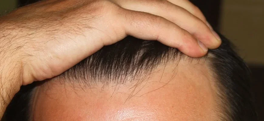 trapianto capelli risultati