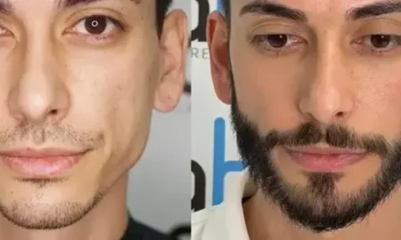 trasplante de barba en Turquía