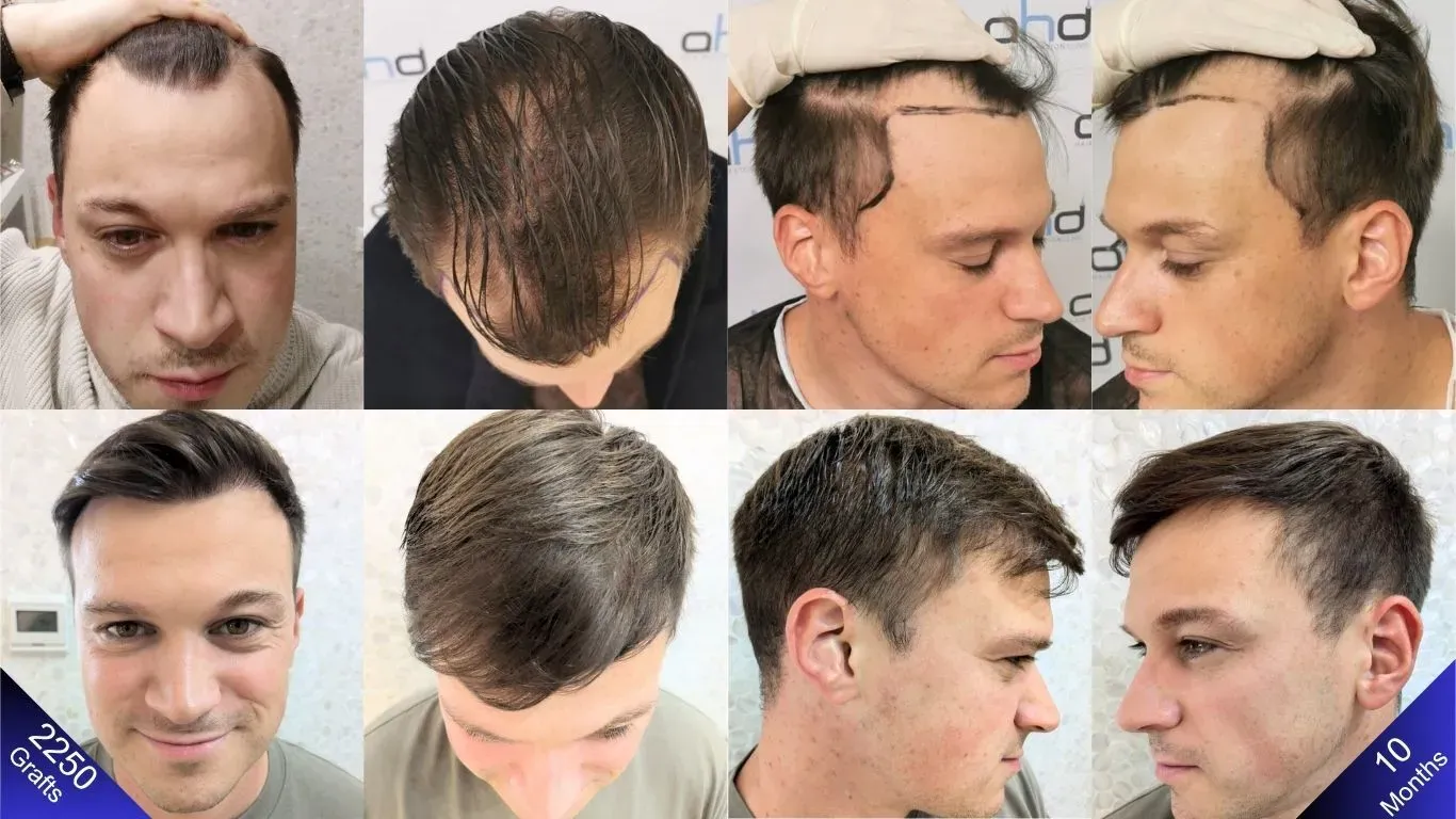 We vergelijken de voor- en nafoto's van een man die een haartransplantatie heeft ondergaan.