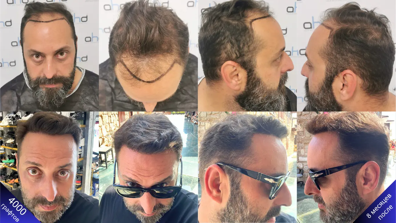 Отличные фото до и после пересадки 4000 графтов волос