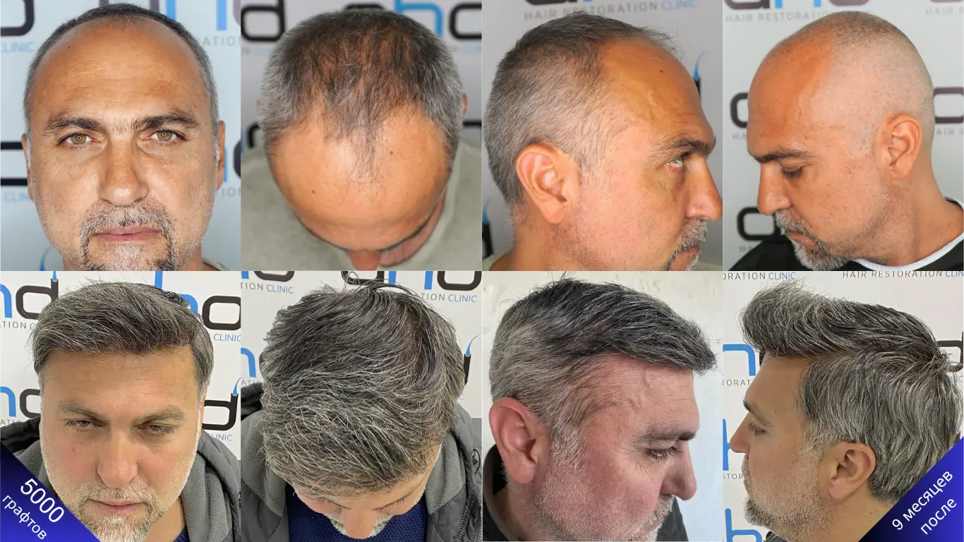 Трансплантация 5000 волосяных графтов при алопеции 5-й стадии по шкале Норвуда и отдаленный результат (1 год)