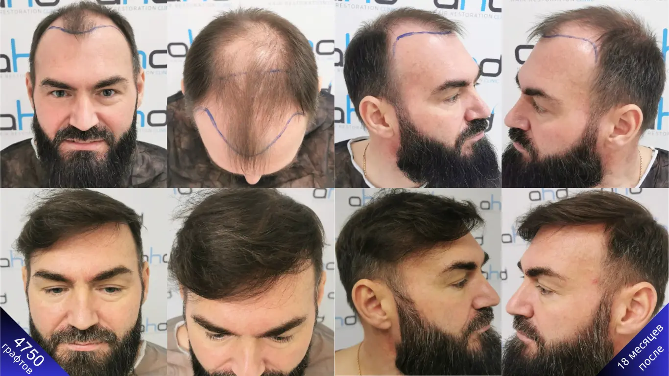 Невероятные результаты до пересадки волос по шкале Норвуд 6 и через 18 месяцев после