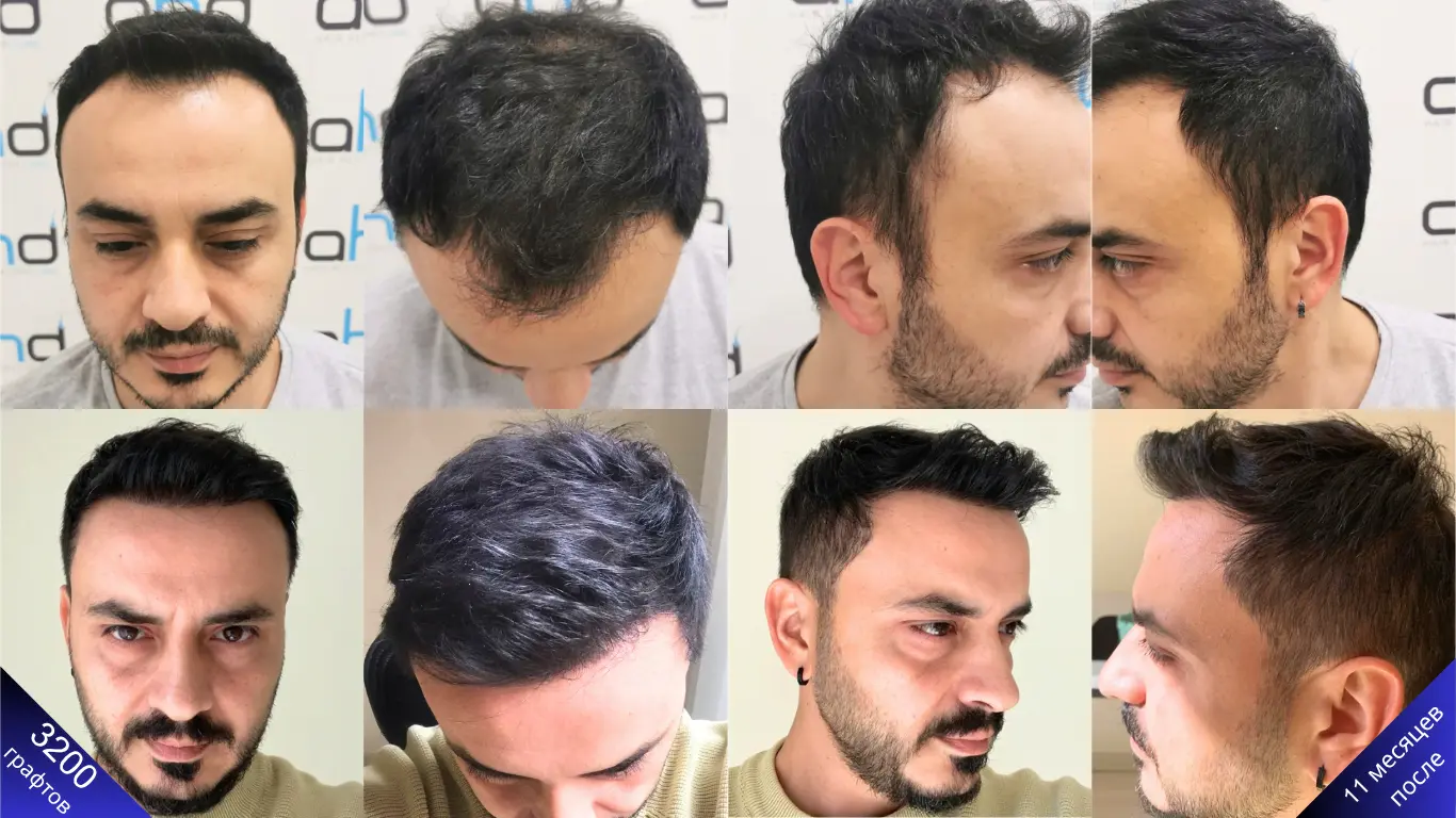 Результат через 1 год после пересадки волос DHI