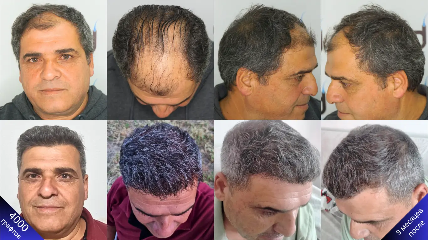 4000 графтов: фото до пересадки волос и потрясающий результат через 9 месяцев