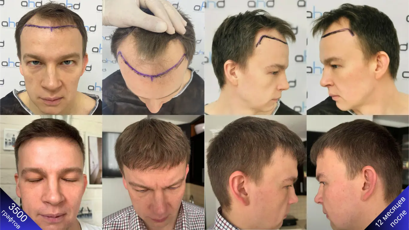 Невероятные изменения благодаря пересадке 3500 графтов волос