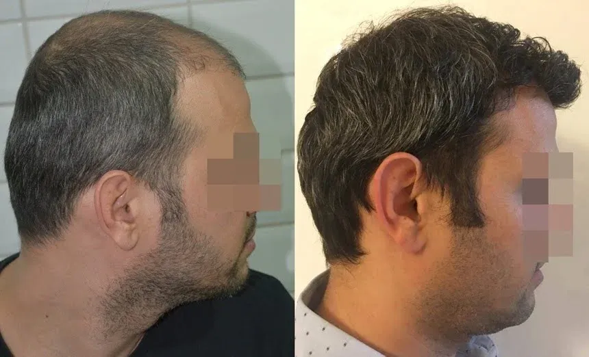 Результат после пересадки волос через 12 месяцев