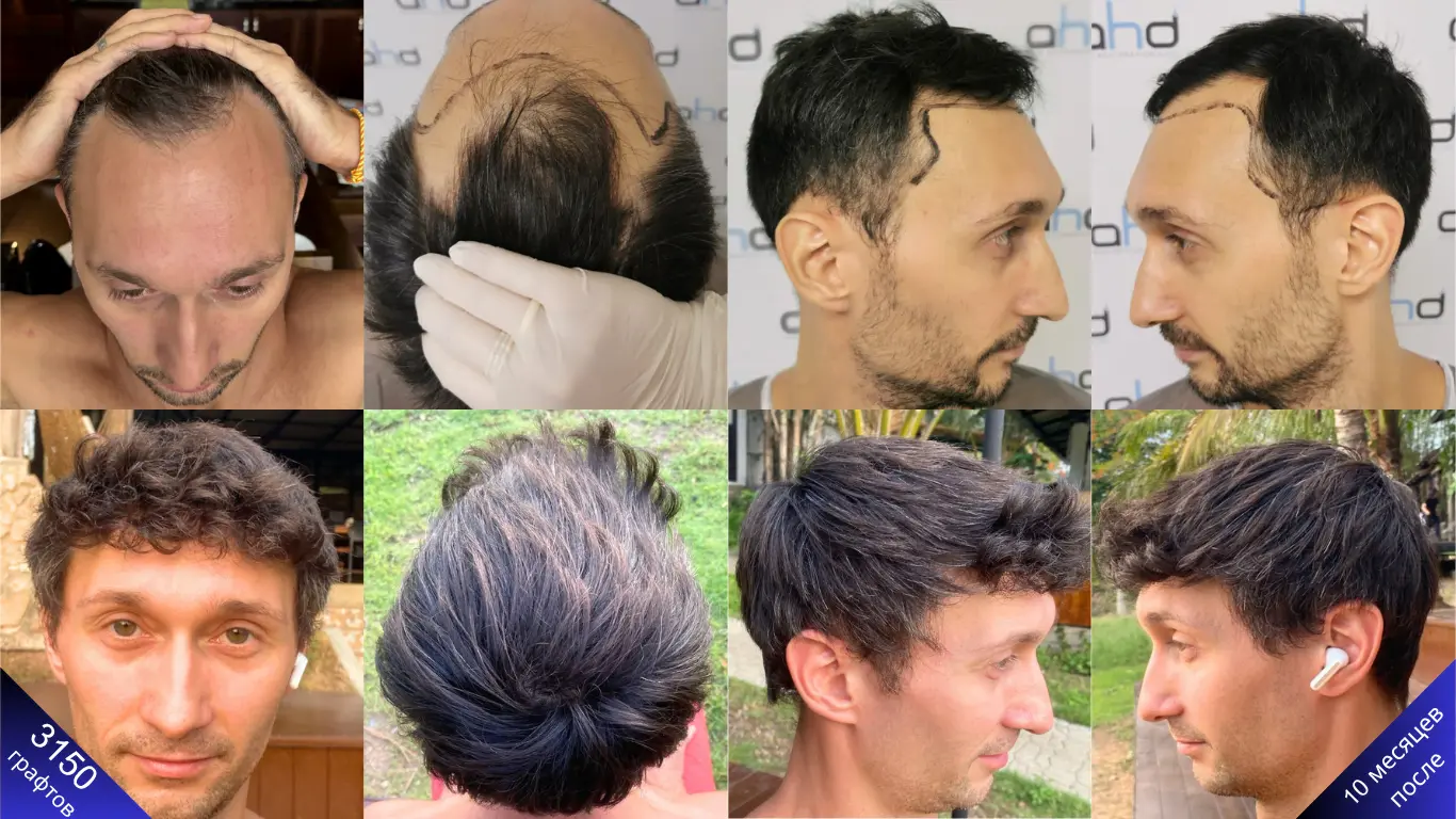 Если вы хотите увидеть потрясающие изменения в пересадке волос, посмотрите на фото