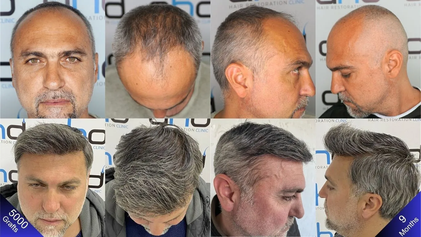 Before photos and the amazing 9-month results of a man who had a 5000-graft hair transplant in Turkey.