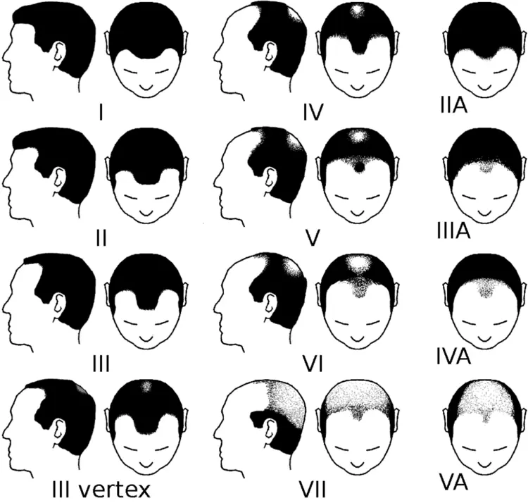 Classification de Norwood de la perte de cheveux