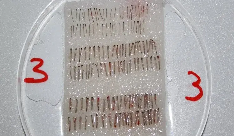 Haartransplantatie met enkelvoudige, dubbele en meervoudige grafts