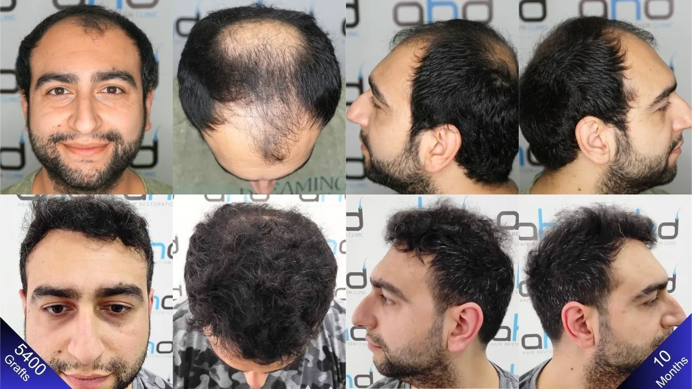 A man's hair transplant results after 10 months – side (right/left), top, and front views.