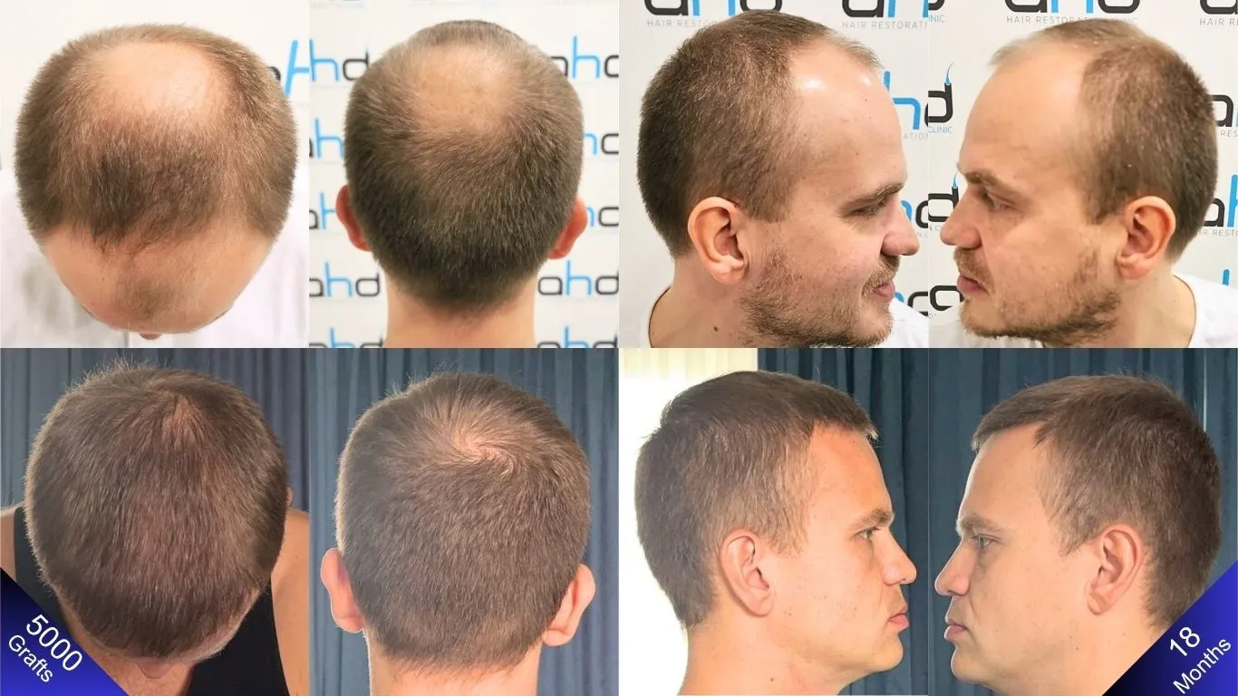 In hair transplantation performed in Turkey, a natural result is achieved both before and after.