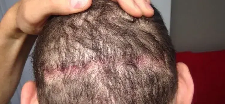Un cattivo candidato per il trapianto di capelli e una zona donatrice scarsa.