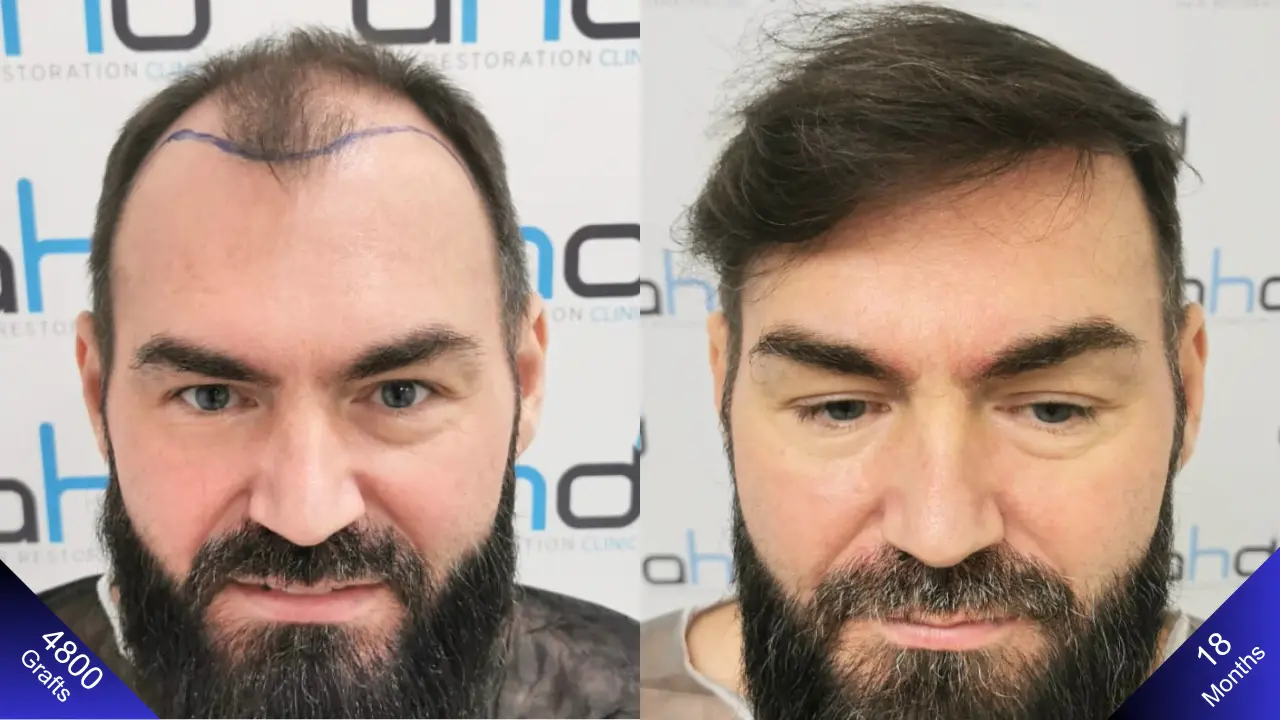 Zeker een gelukkige man van wie het gezicht oplicht met een haartransplantatie van 5000 grafts.