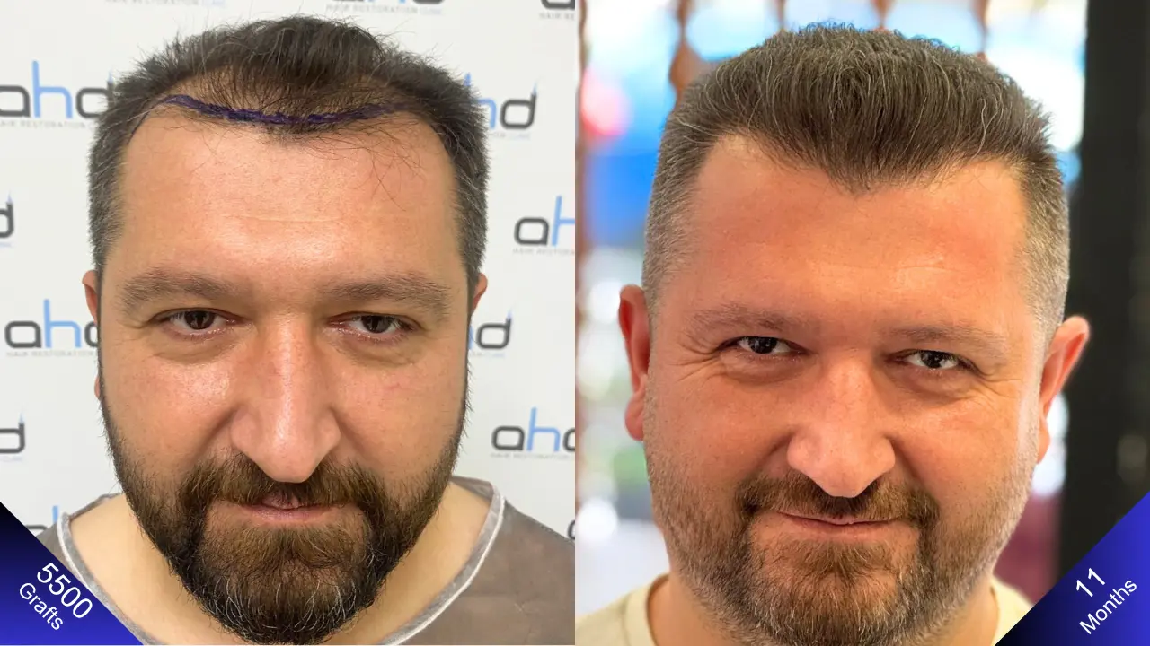 Het Turkse verschil bij een 5000-greffe haartransplantatie: Verbazingwekkende voor- en na-beelden.