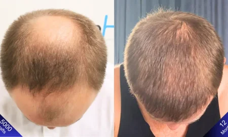 5000 grafts hair transplant
