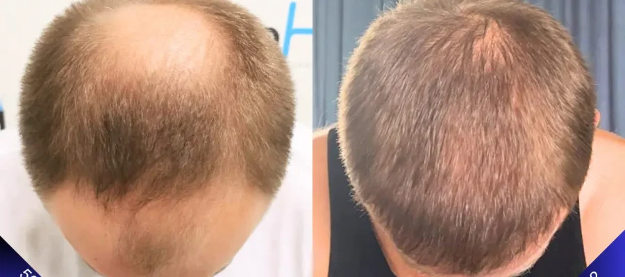 5000 grafts hair transplant