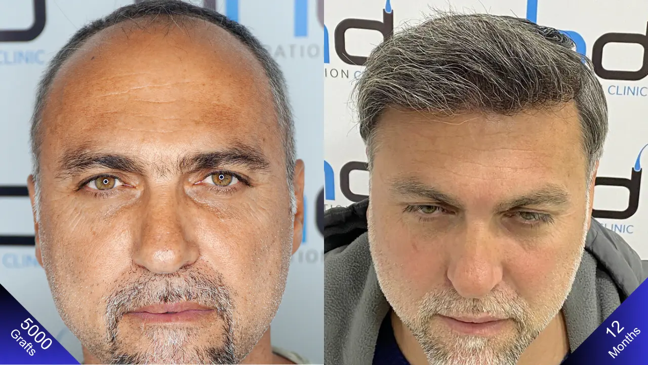 A very nice visual showing before the hair transplant and 1 year after