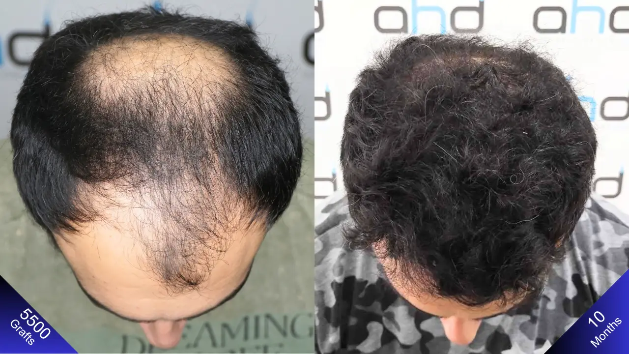 5500 graft hair transplant and the amazing results after 1 year