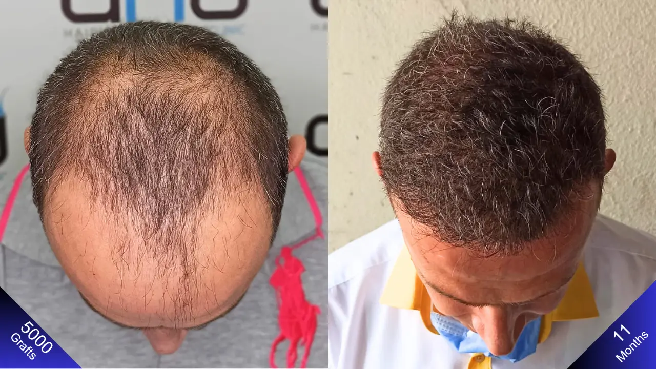 Before and after results of a Norwood 5 hair transplant – 1-year progress