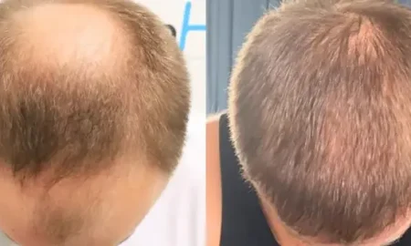 5000_grafts_hair_transplant