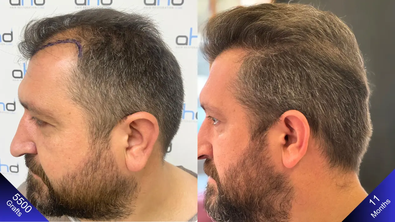 Een ander van de beste haartransplantatieresultaten