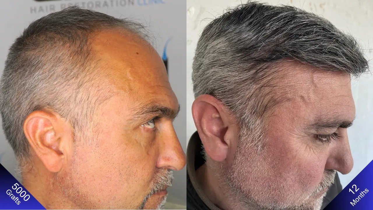 Een dichte en natuurlijk ogende haartransplantatie met 5000 grafts.