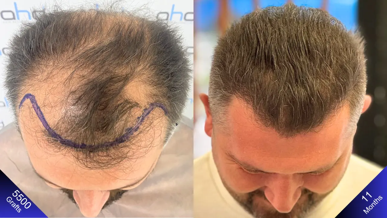 Luchtfoto van een haartransplantatieprocedure in Turkije