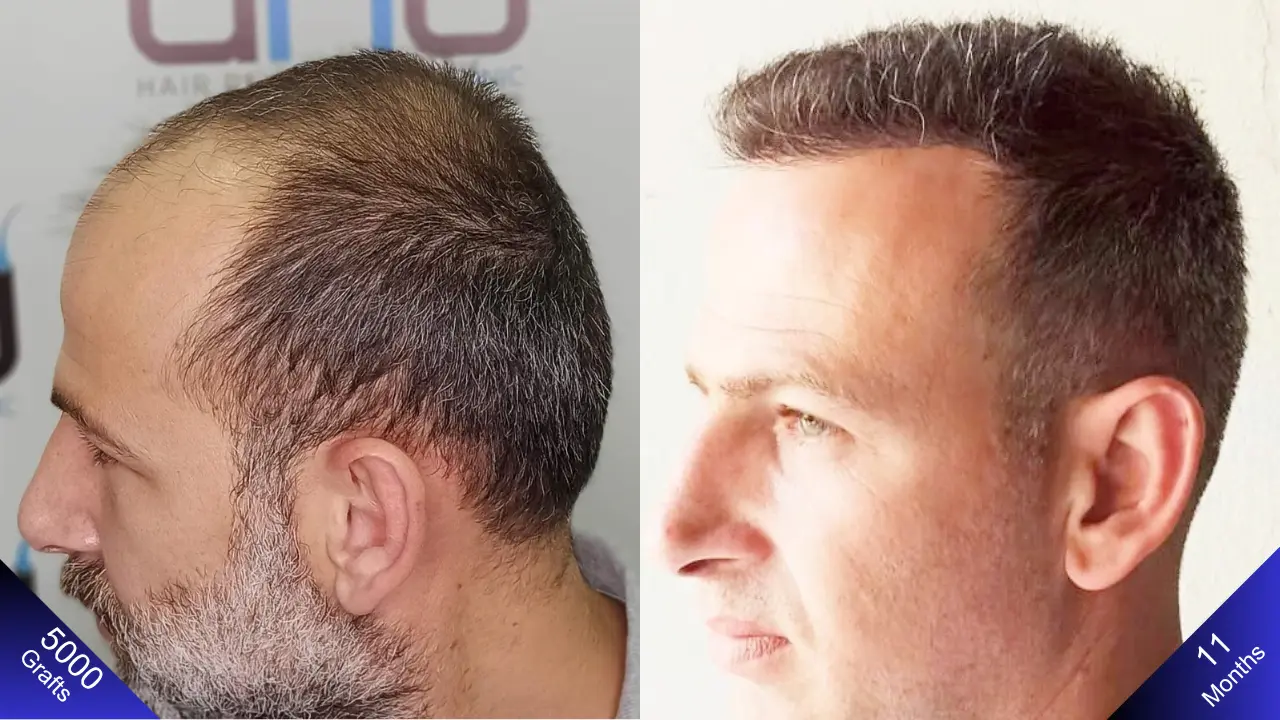 De man die ongelukkig was vóór de haartransplantatie heeft een jaar later een lachend gezicht.