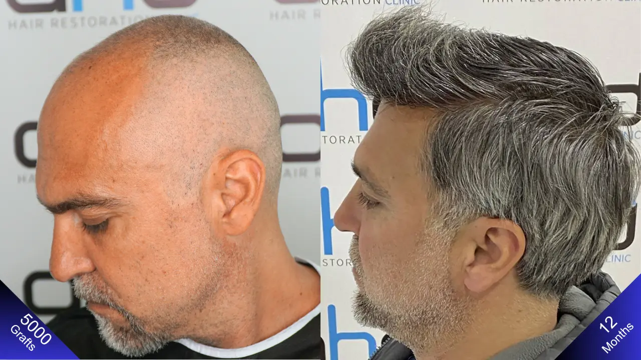 Der natürliche und volle Look, der durch eine Haartransplantation mit 5000 Grafts entsteht.