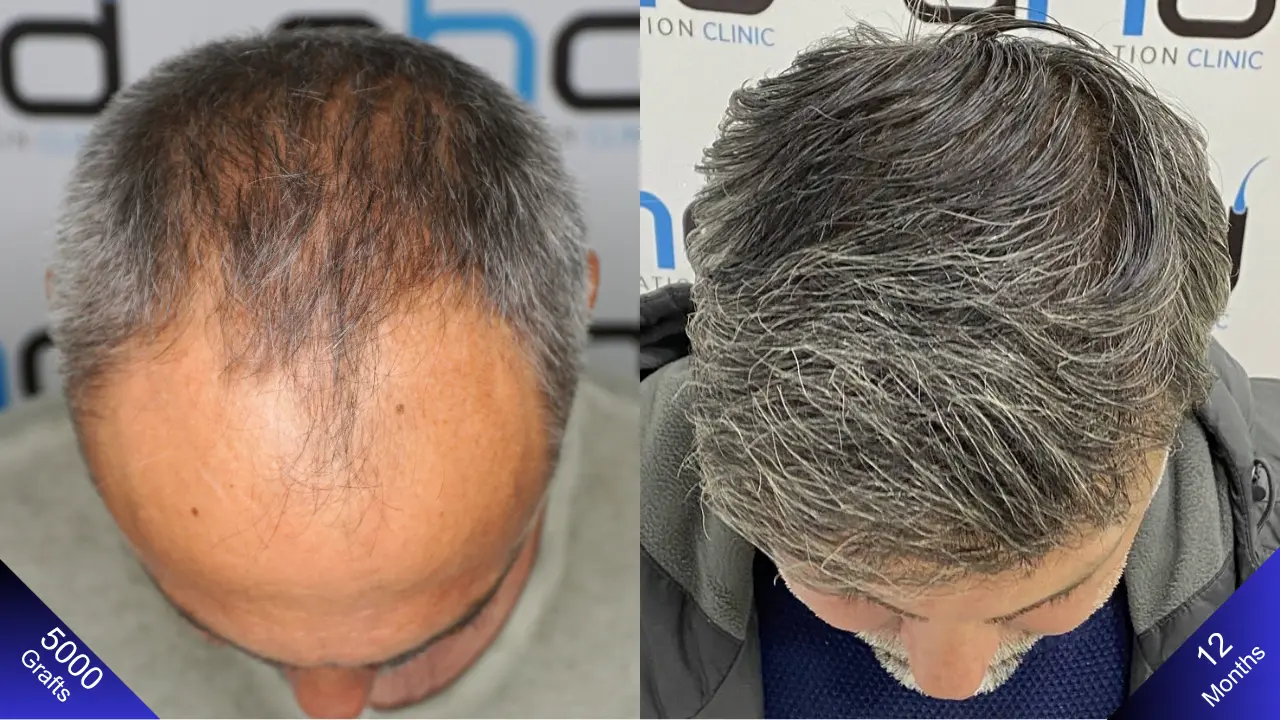 Bovenaanzicht van een Norwood 5 man, één jaar na zijn haartransplantatie