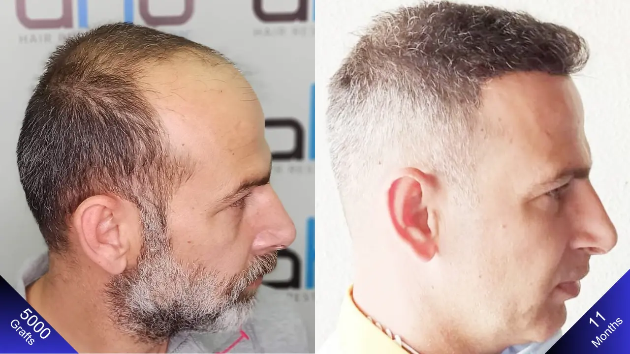 Natuurlijke en hoogdichtheid haartransplantatie