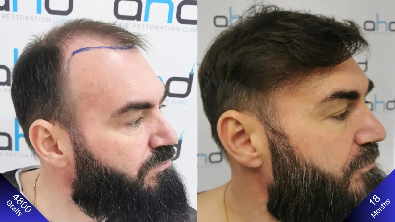 A comprovação de um resultado natural após o transplante capilar.