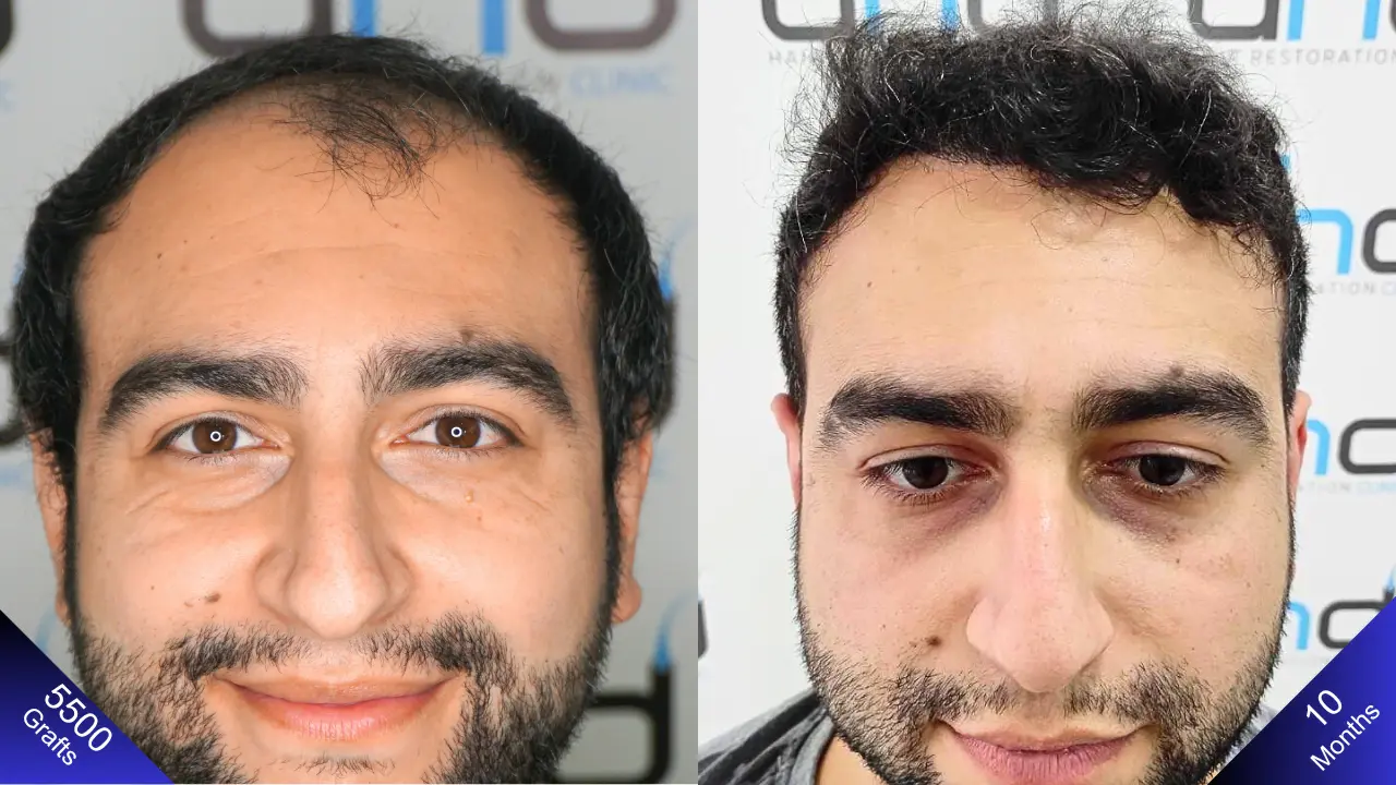 The fantastic outcome from 5500 grafts