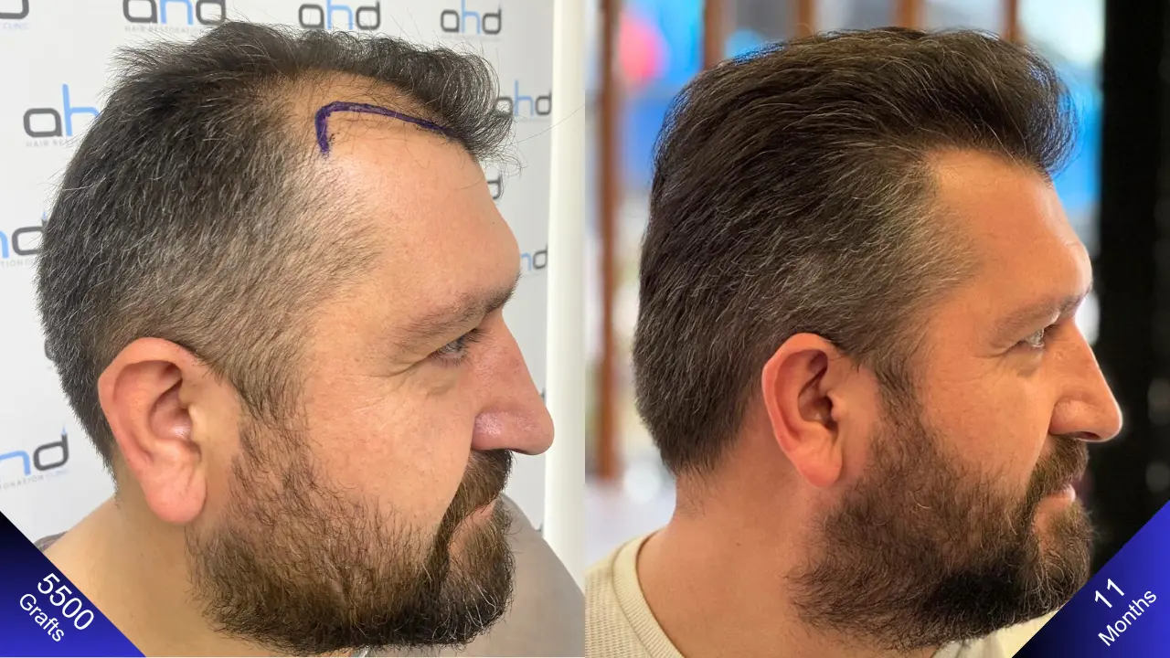 Kijk naar het haartransplantatieresultaat van 5000 grafts vanaf de rechterkant.