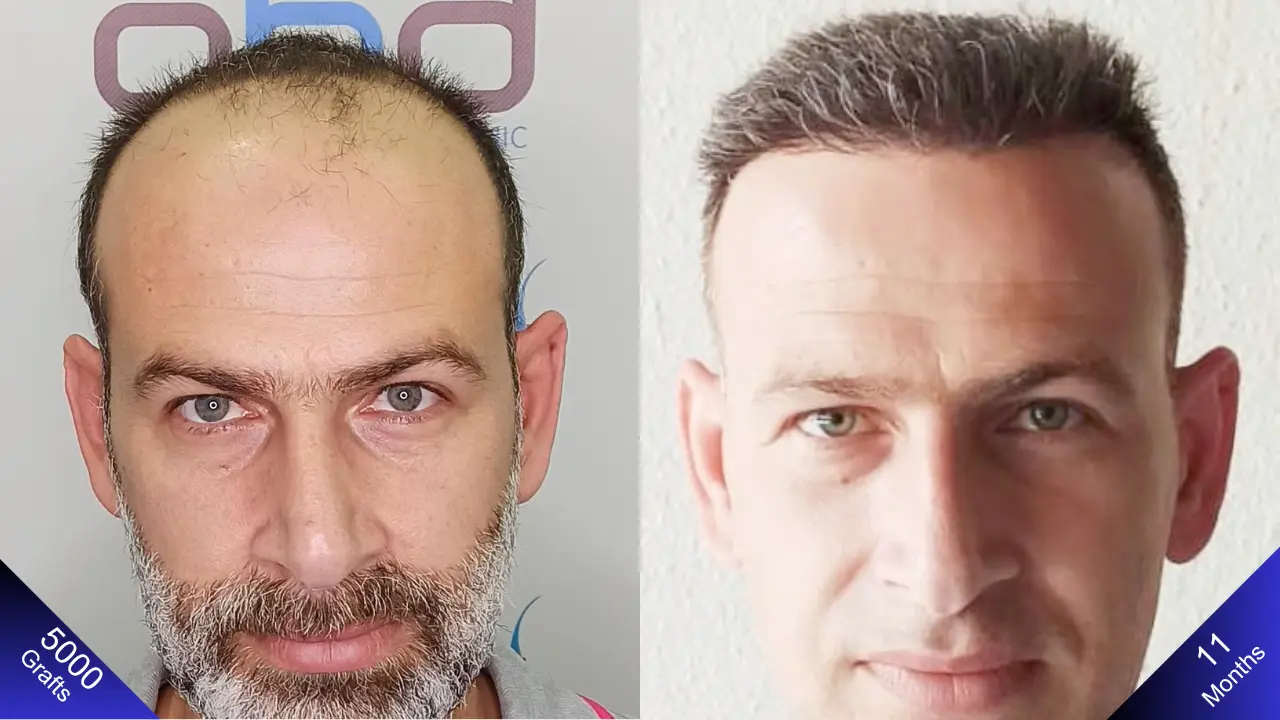 5000-graft DHI hair transplant with fantastic results