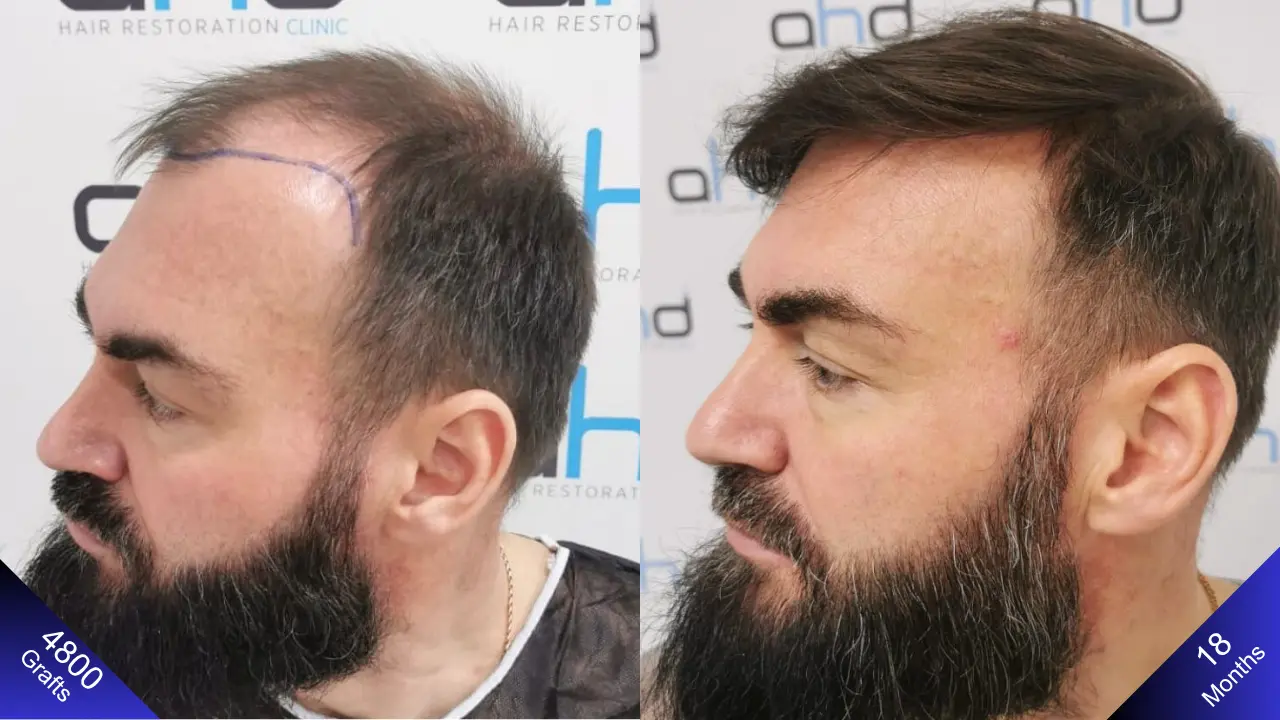 Een fantastisch resultaat van een haartransplantatie