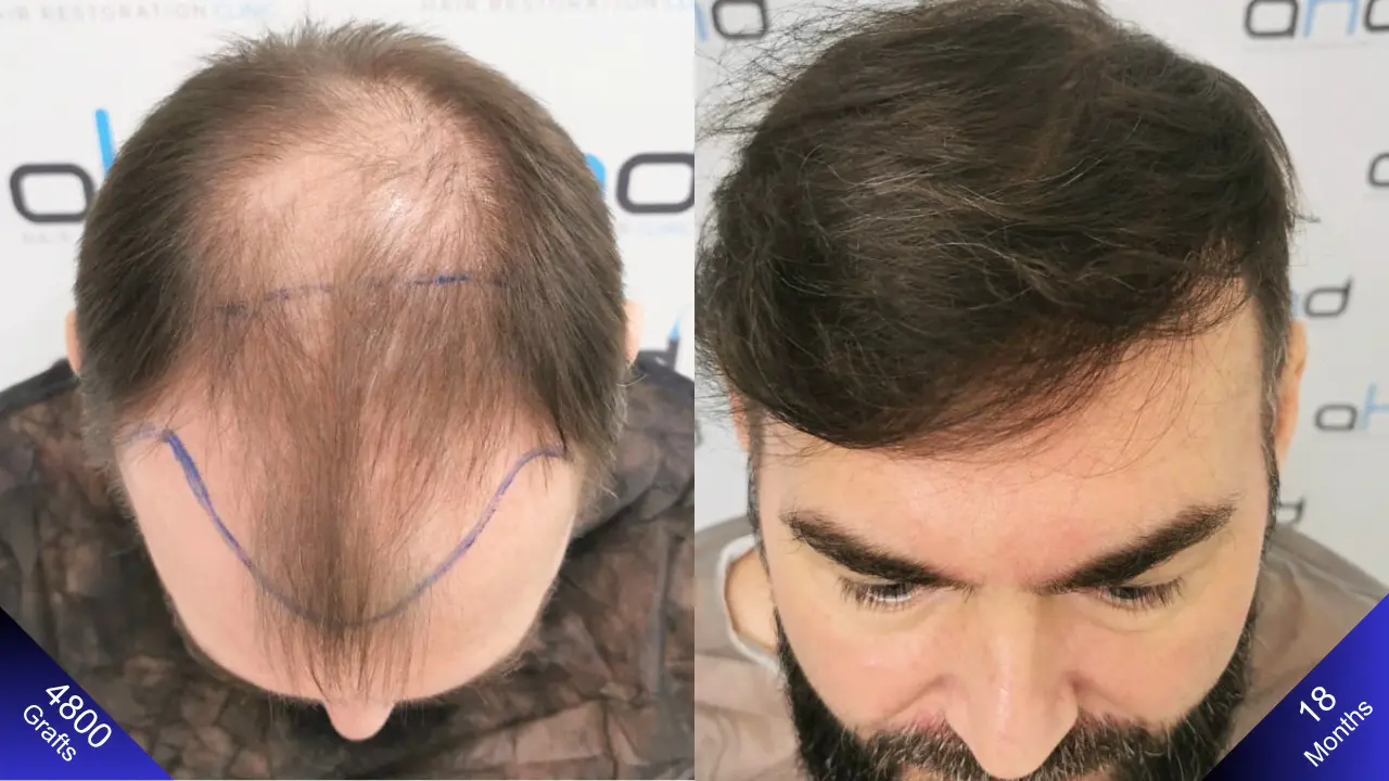 Het bovenaanzichtresultaat van een haartransplantatie van 5000 grafts