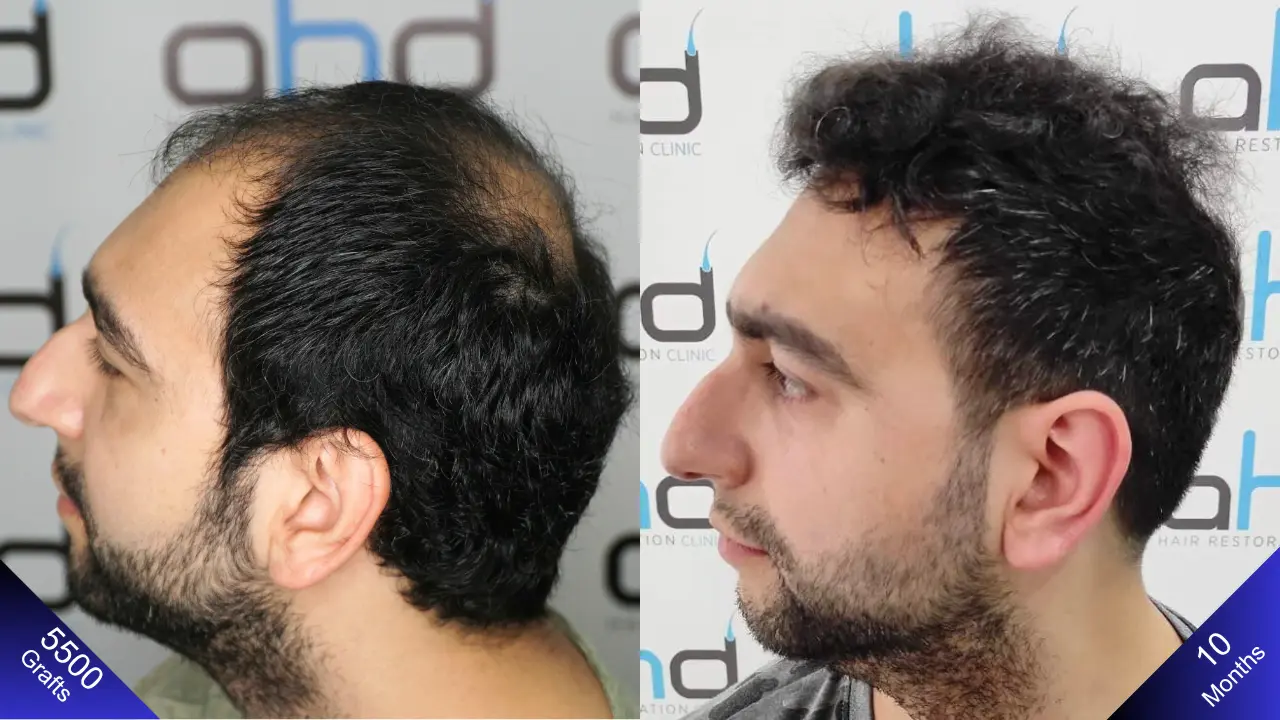 1 year after hair transplant, view from the left side