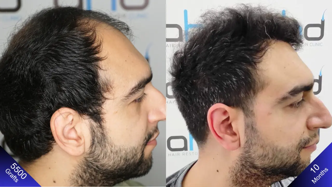 Amazing results in hair transplantation performed in Turkey