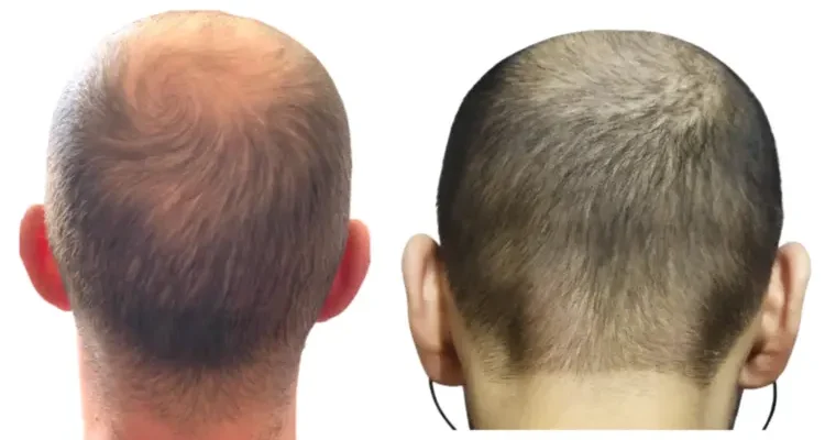 Un donneur qui n'est pas adapté à la greffe de cheveux